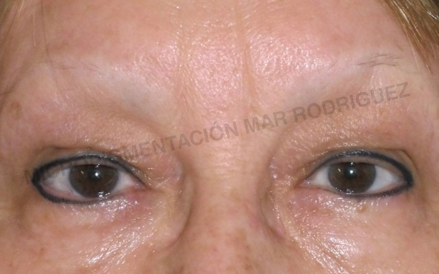 Micropigmentación Mallorca Paramédico  Centro
