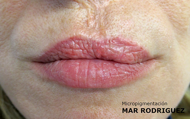 Labio Leporino Micropigmentación Mallorca Paramédico Centro