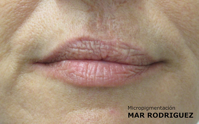 Labio Leporino Micropigmentación Mallorca Paramédico Centro