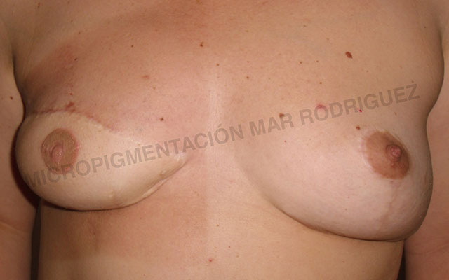 Micropigmentación Mallorca Paramédico  Centro