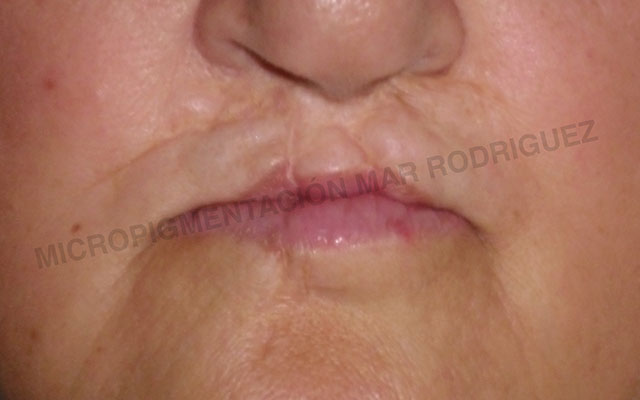 Labio Leporino Micropigmentación Mallorca Paramédico Centro
