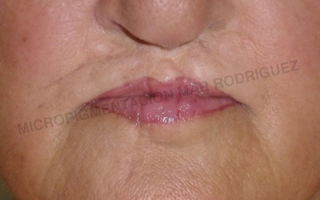 Labio Leporino Micropigmentación Mallorca Paramédico  Centro