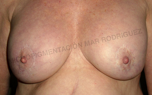 Micropigmentación Mallorca Paramédico  Centro