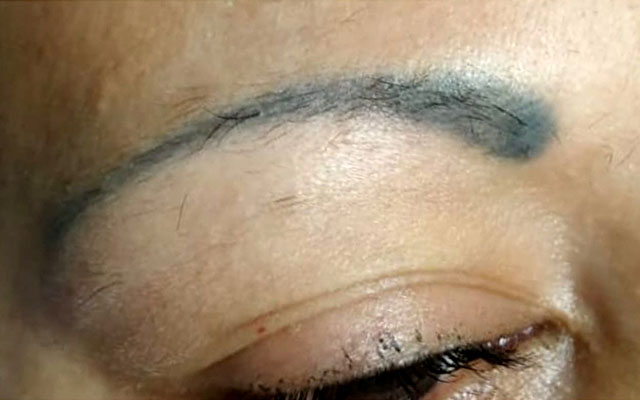 Micropigmentación Remover Mallorca Centro Palma